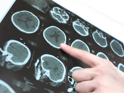 Um neurologista assinala as imagens de um cérebro humano obtidas por scanner.