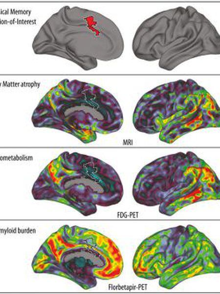 O gráfico mostra (em vermelho, acima) o giro cingulado anterior, onde as memórias musicais são armazenadas. Mais abaixo, visão bilateral de três biomarcadores da doença de Alzheimer; em vermelho, as áreas mais afetadas.