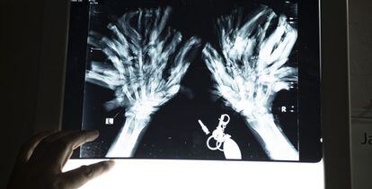 O médico Samanto Lal Sen mostra uma radiografia das mão de Bajandar: “Não é fácil lidar com os dedos, e temos que ter cuidado para não danificá-los”