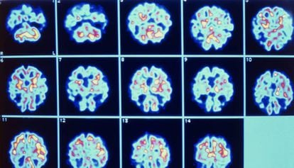 Série de imagens do cérebro de um paciente com Alzheimer obtidas através de PET.