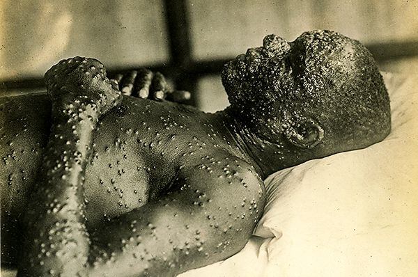 Homem com as bolhas da varíola: após campanha mundial, OMS anunciou erradicação da doença em 1980.